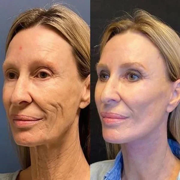 Botox Facial Essence