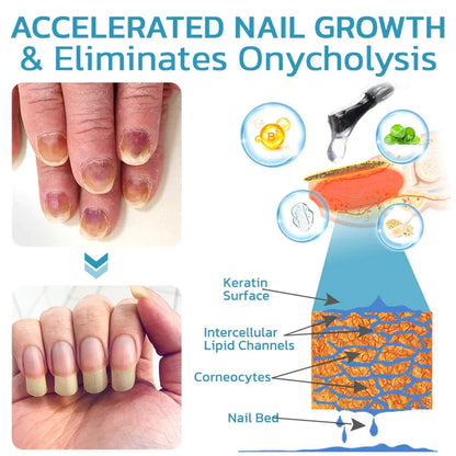 OnycholysisHeal Nail Strengthening And Growth Conditioner