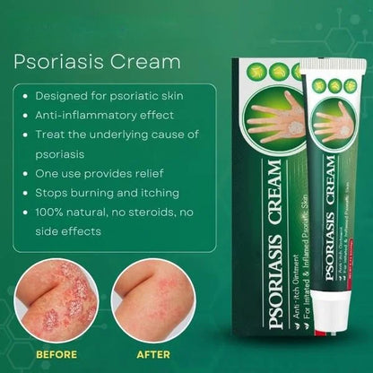 Psoriasis Treatment Cream